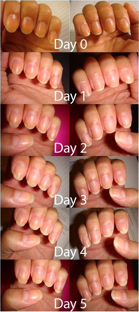 Nutra Nail 5 to 7 Day Growth Treatment - Fast Keratin Nail Strengthener  Repair Serum Formula for Thin, Brittle, & Damaged Nails (0.47 fl oz) -  Walmart.com